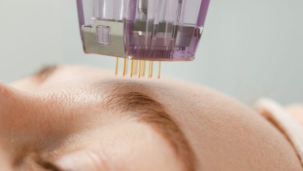 ολικό lifting προσώπου, λαιμού και ντεκολτέ πριν από τις γιορτές για φυσική ανόρθωση χωρίς νυστέρι.