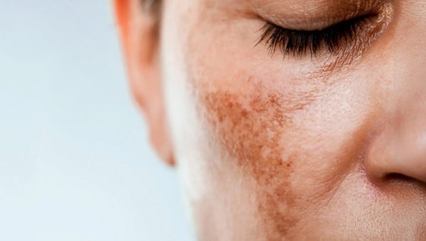 bionomehealthclub – μέλασμα – πρόσωπο μέλασμα στο πρόσωπο