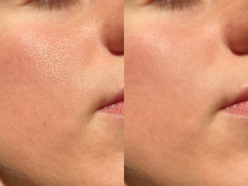 before after skin reset